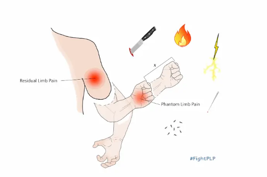 Diagram of phantom limb pain